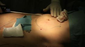 liposuction