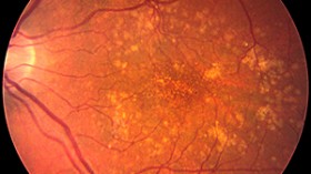 retina, macular degeneration 