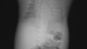  Hypophosphatasia in a male neonate