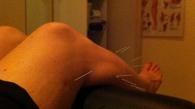 Acupuncture More Cost Effective to Treat Knee Osteoarthritis