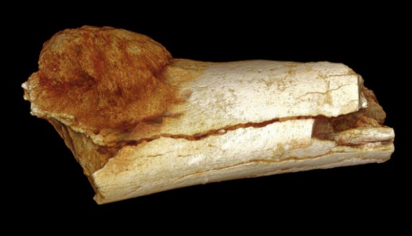 Earliest Cancer on Hominin