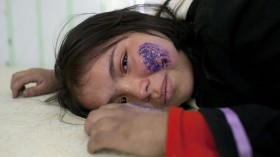 Leishmaniasis Skin Disease Plagues Afghans