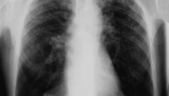 Chest X-ray