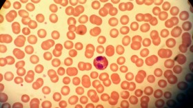 Histological blood smear of an eosinophil surrounded by red blood cells and platelets