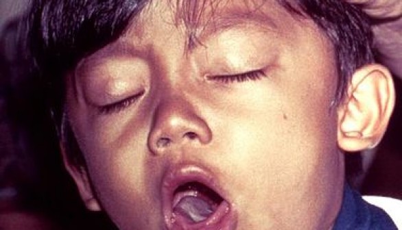 A young boy coughing due to pertussis.