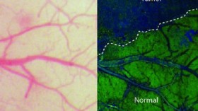 Tumor and brain tissue