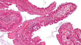 A pre-malignant lesion of the colon