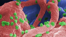 human immunodeficiency virus (spherical) on human lymphocytes.