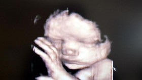 Stock Photography. A 3d Ultrasound Showing A Baby