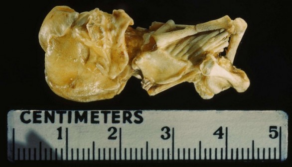 Petrified fetus