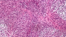 Micrograph of malignant peripheral nerve sheath tumour 