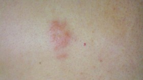 Rash caused by Herpes zoster.