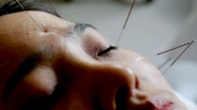 Acupuncture