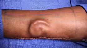 Ear Grown In Forearm