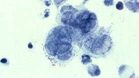 Herpes virus within tissue removed from a genital sore