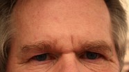 Deep Forehead Wrinkles Mark A Higher Risk Of Dying From Cardiovascular 