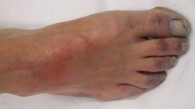 Photo of a foot infected with Ischemia