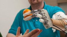 Amputee with prosthetic hand that feels 