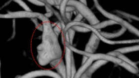 Blood Vessel Showing An Aneurysm Circled in Redblood Vessel Showing An Aneurysm Circled in Red (IMAGE)