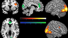 Neural Responses to Facial Disfigurement (IMAGE)