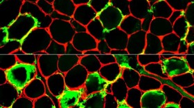 Immune Myopathy (IMAGE)