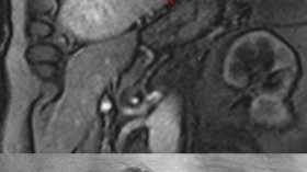 Measuring Blood Flow in the Myocardium with Magnet Resonance Imaging (IMAGE)