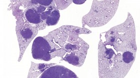 Lung Tumors (IMAGE)