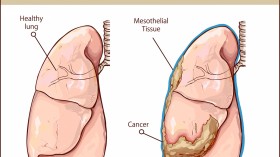 Ofev Drug Fails in Mesothelioma Clinical Trial