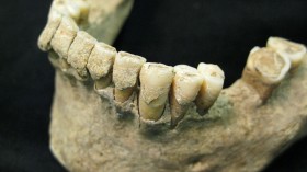 Fossilised dental plaque (calculus) on the teeth of a middle-aged man from the Medieval site of Dalheim, Germany, ca. AD 1100. 