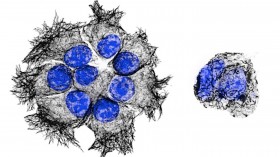 Pancreatic Cancer Cells (IMAGE)