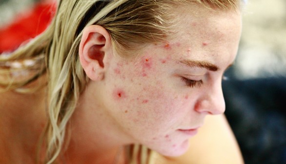 Can Dietary Changes Cure Acne?