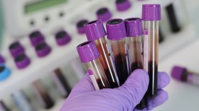 People with Blood Type A More Prone to COVID-19, Study Says