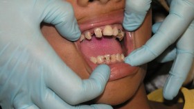 Psychological Impact of Bad Teeth