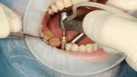 Five of the Most Common Types of Dental Surgery