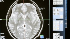 A patient's brain scan