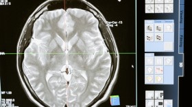 A patient's brain scan