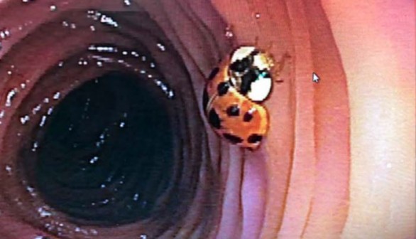 Ladybug Crept Inside Sleeping Man, Appears Later in Colonoscopy!