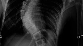 scoliosis 