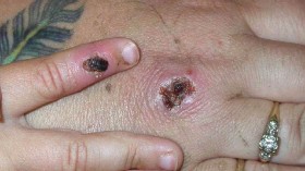 Monkey Pox Lesions