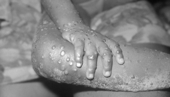 Monkeypox Outbreak Reaches Canada, U.S. with Confirmed Cases