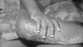 Close-up of monkeypox lesions on the arm and leg of a female child.