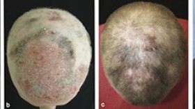 These panels show the patient's head a) before treatmen with tofacitinib, b) two months into treatment, c) five months into treatment, and d) eight months into treatment.