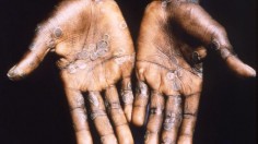 Debunked: Possibility of Monkeypox Spread Through Sexual Transmission