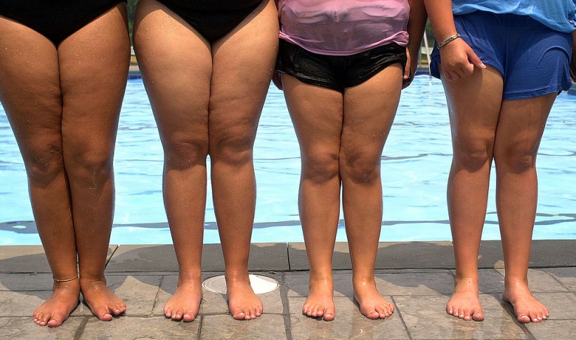 Childhood overweight and childhood obesity