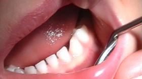 Milk teeth