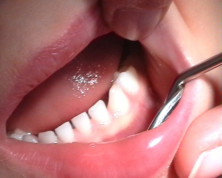 Milk teeth