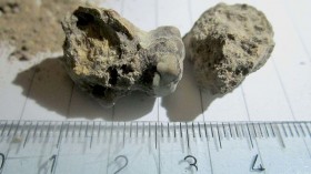 Kidney stones