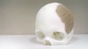 75 Per Cent of Man's Skull Replaced by Implant Created by 3D Printer