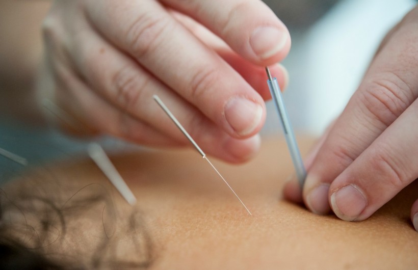 acupuncture, wellness, eastern medicine, and pain relief