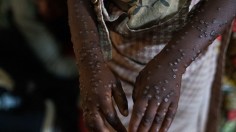 Monkeypox Evolution Reaches Deadly Strain, Now Detected in US